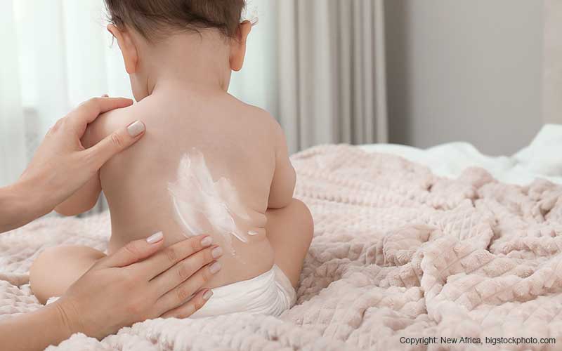 Neurodermitis Baby – Was wirklich hilft bei trockener, juckender Babyhaut